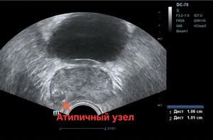 ТРУЗИ, атипичный узел